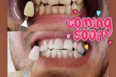Endlich ist unser neuer Alexandrit Laser da!
