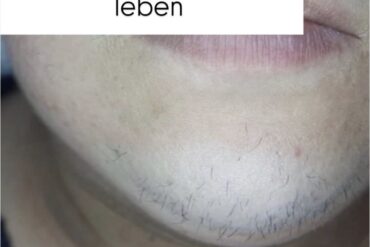 Endlich ist unser neuer Alexandrit Laser da!