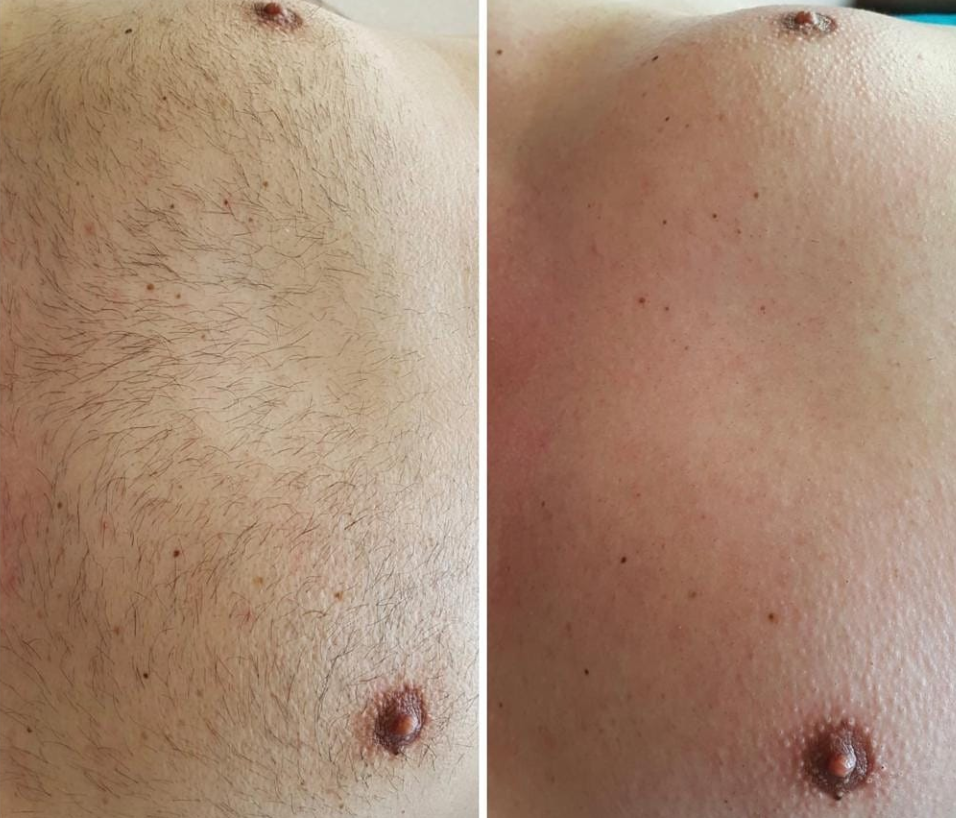 vorher-nachher-waxing